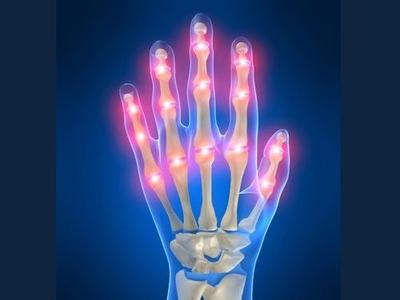 Clinical trials of new drug for gout will be launched in China